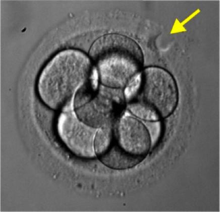 Laser Hatching of Vitrified Embryos FCNE
