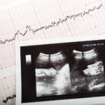 Does IVF Increase the Risk of Fetal Cardiac Defects?
