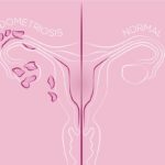 Endometriosis and Infertility