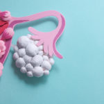 Treatment Options for Polycystic Ovarian Syndrome (PCOS)