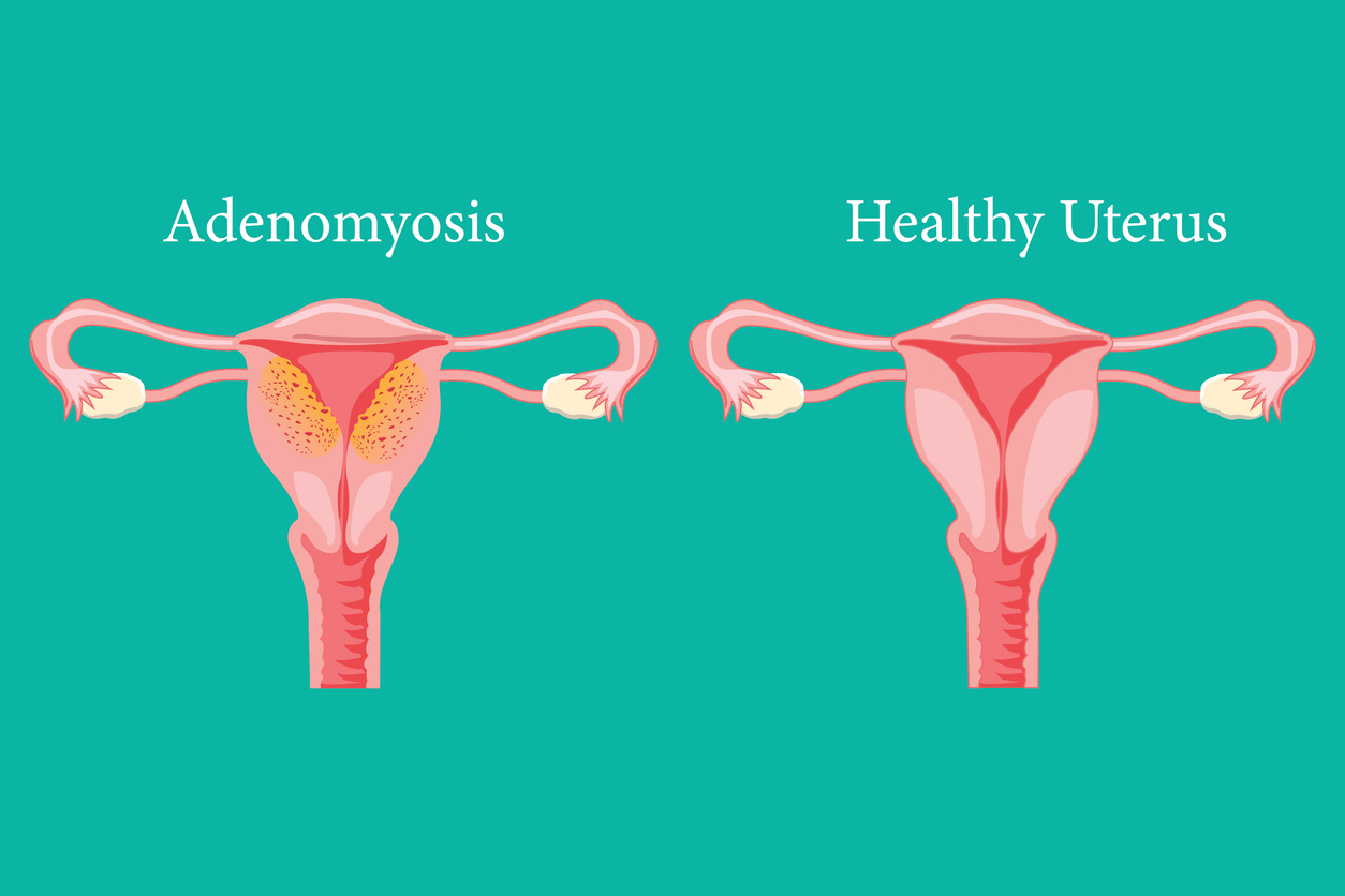 Adenomyosis And Pregnancy Fertility Centers Of New England Adenomyosis And Pregnancy Fertility Centers Of New England